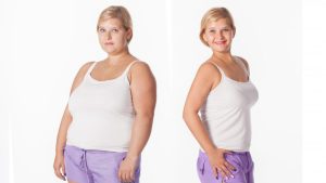 A simple guide to bariatric (weight-loss) surgery